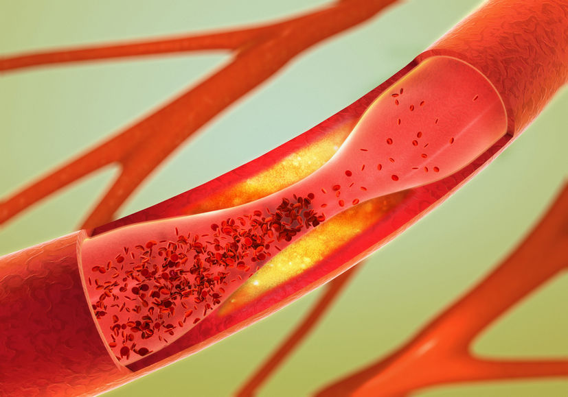 Ausfällen und Verengung der Blutgefäße - Arteriosklerose