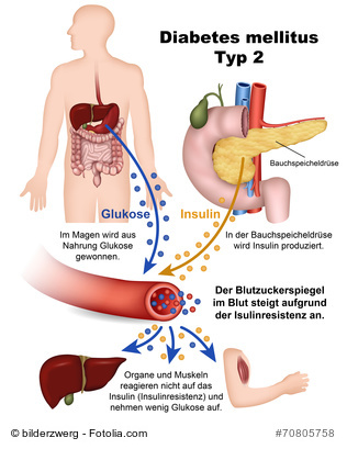 diabetes mellitus typ 2, illustration mit beschreibung