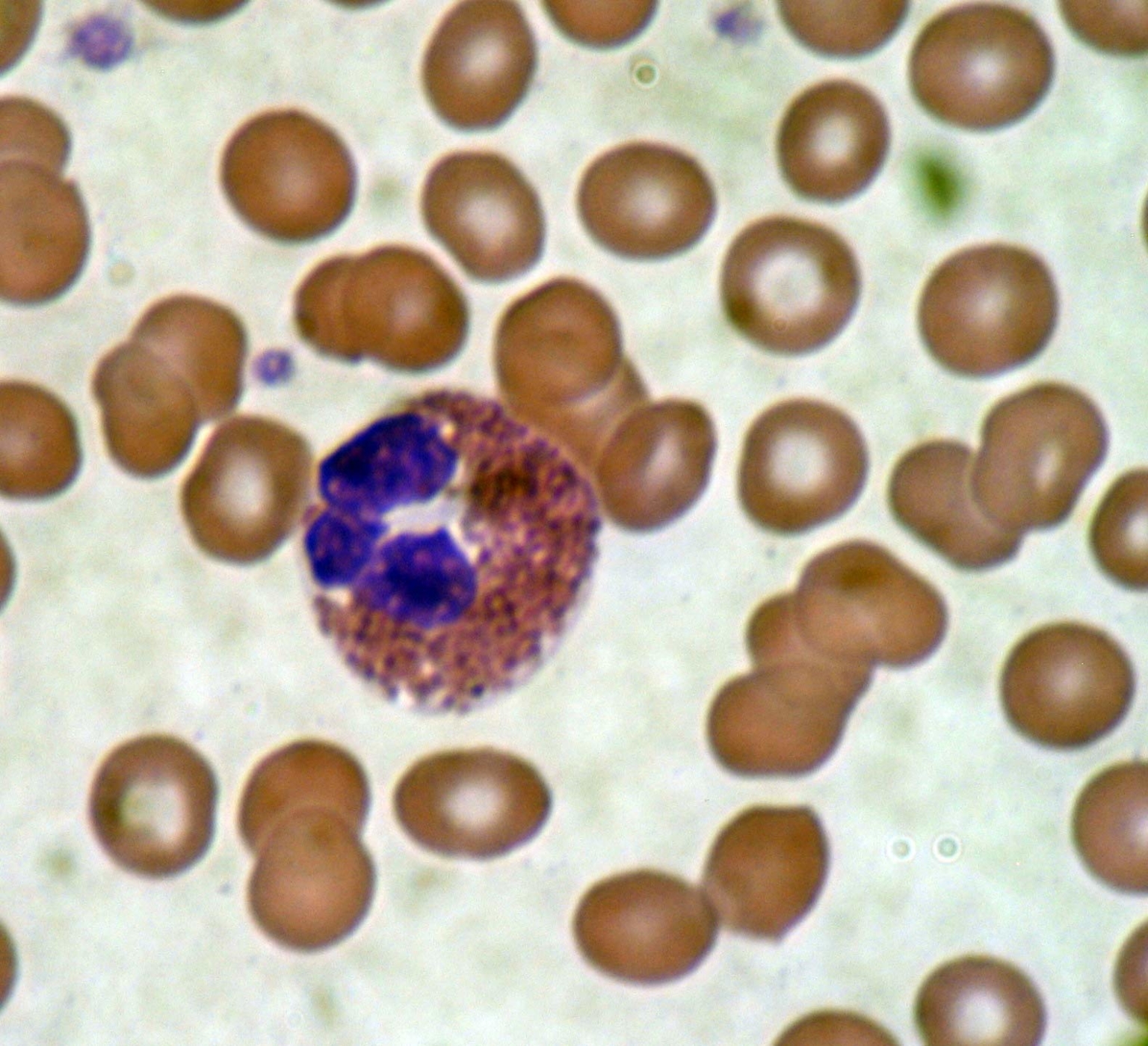 Eosinophilie erhöhte eosinophiler Granulozyten die Ursachen sind