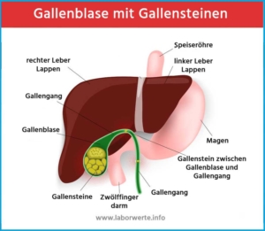 Gallenblase und Gallensteine