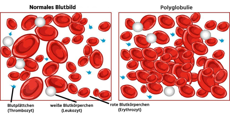Was Bedeutet Zu Viele Rote Blutkörperchen www.laborwert.info