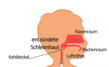 ᐅ Pseudokrupp: Symptome & Behandlung - Ratgeber für Eltern