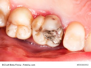 Wie lange hält die Amalgam Füllung