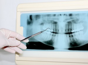 Ein Röntgenbild von Zähnen